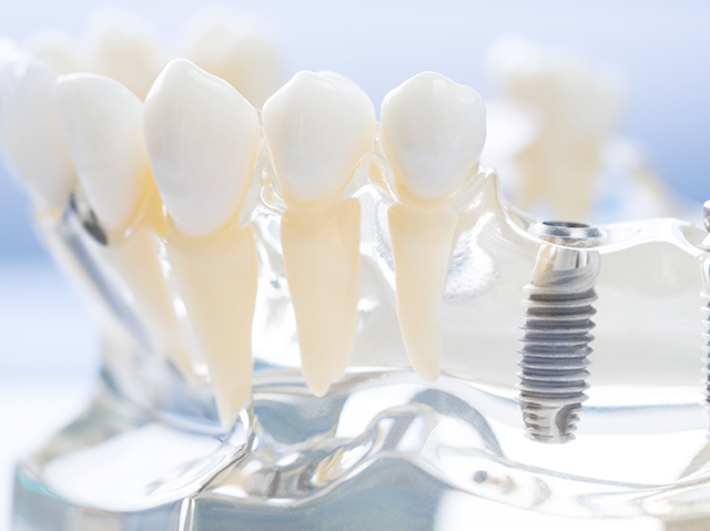 歯茎が透明になっている模型とインプラントのイメージ